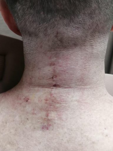 Post-surgical spinal cord injury scar